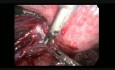 Endométriose sévère - prise en charge laparoscopique