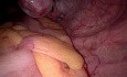 vNOTES Salpingectomie utilisant le port SILS pour la grossesse extra-utérine