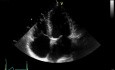 Une maladie rénale chronique - la cause de la calcification de la valve mitrale et aortique