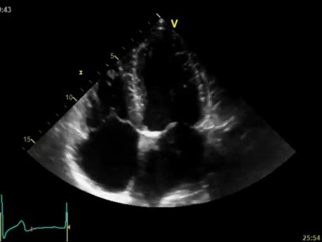 Une maladie rénale chronique - la cause de la calcification de la valve mitrale et aortique