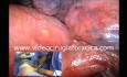 Cancer du Poumon: Lobectomie Supérieure Gauche par Vidéo-Thoracoscopie Uniportale