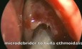 Chirurgie endoscopique fonctionnelle des sinus - Mucocèle ethmoïde