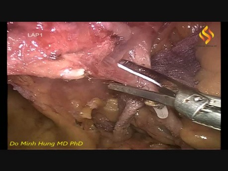 Hémicolectomie droite avec l'exérèse complète du mésocolon par voie laparoscopique