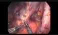 Résection laparoscopique d'un tumeur stromale duodénal