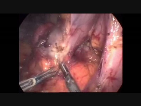 Résection laparoscopique d'un tumeur stromale duodénal