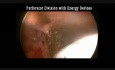 Chirurgie endoscopique des veines perforantes sous-fasciales (CEPS) - une jonction saphéno-poplitée (JSP)