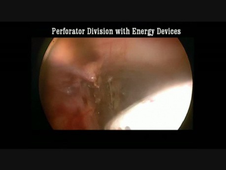 Chirurgie endoscopique des veines perforantes sous-fasciales (CEPS) - une jonction saphéno-poplitée (JSP)