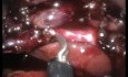 Cholécystectomie Laparo-Endoscopique à Site Unique (LESS) avec Cholangiographie Peropératoire