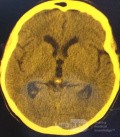  Ventriculostomie endoscopique du troisième ventricule dans un cas bénin du syndrome d'Aicardi avec hydrocéphalie obstructive et malformation de Chiari de type 1.