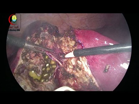 Déchirure de la Vésicule Biliaire lors d'une Cholécystectomie Laparoscopique