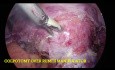 Hystérectomie Totale Laparoscopique - Utérus Fibromateux