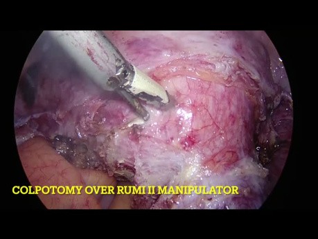 Hystérectomie Totale Laparoscopique - Utérus Fibromateux