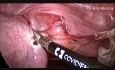 Hystérectomie laparoscopique totale et cholécystectomie chez la même patiente
