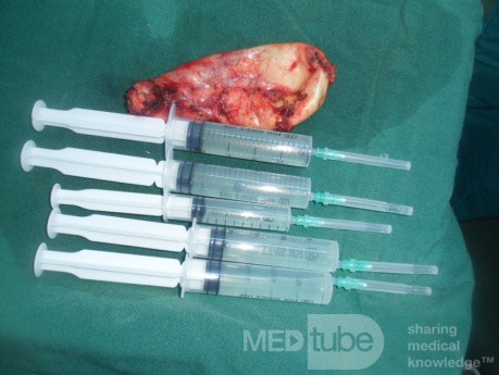 Une vésicule biliaire après une résection laparoscopique.