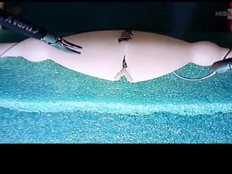 Anastomose Intra-corporelle sur un Simulateur