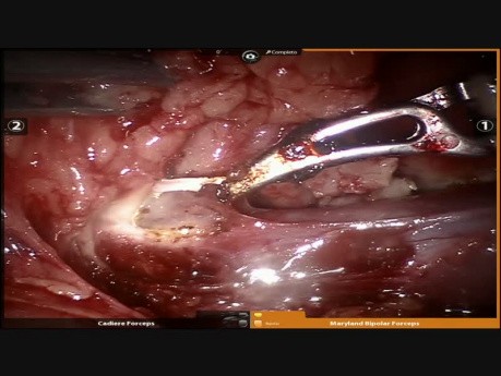 Résection robotique d'un thymome - approche bilatérale