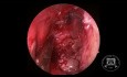 Résection de papillome inversé (vidéo HD)