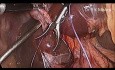 Cholécystectomie laparoscopique avec ligature du canal cystique