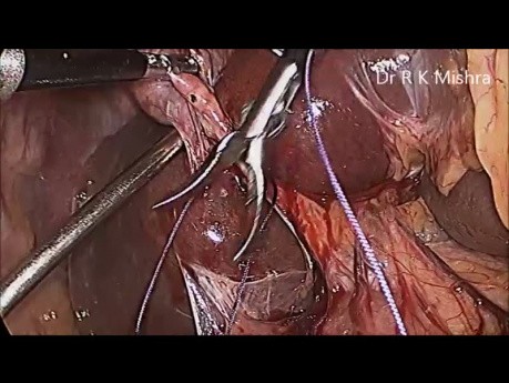 Cholécystectomie laparoscopique avec ligature du canal cystique
