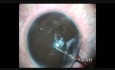 Implantation de la griffe d'iris dans l'aphakie traumatique