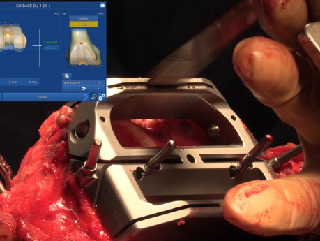  Prothèse totale de genou naviguée par le dr Océane Brunet a l'hôpital prive d'Antony