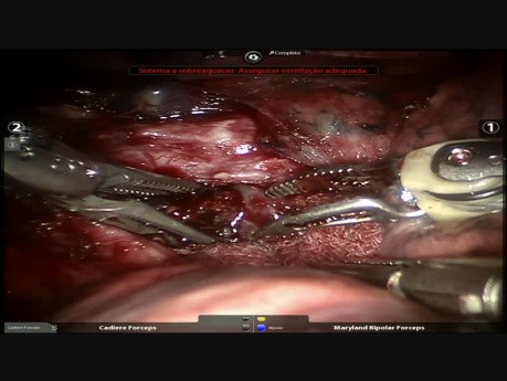 Segmentectomie anatomique S2, chirurgie robot-assistée