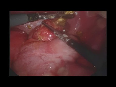 Ablation Laparoscopique d'un Corps Etranger Perforé Simulant une Appendicite Perforée Aiguë