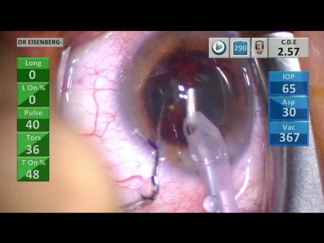 Chirurgie de la cataracte avec des métriques d'apprentissage de la chirurgie de la cataracte