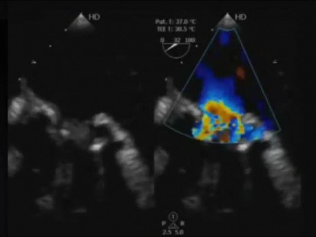 Cas clinique: endocardite infectieuse d'une prothèse de valve mitrale. Échocardiographie transœsophagienne