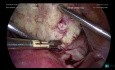 Fibrome cervical antérieur