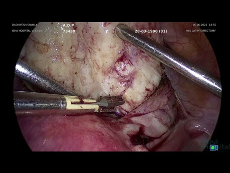 Fibrome cervical antérieur