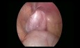 Orchiopexie laparoscopique bilatérale