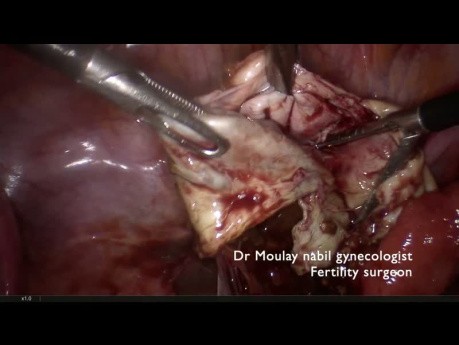 Stratégie coeliochirurgicale pour le traitement du kyste endometriosique ovarien dans le cadre de l'infertilité