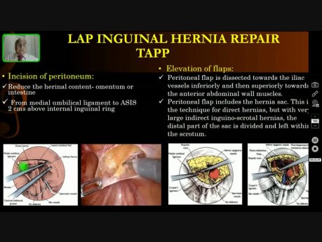 Cure de hernie inguinale par voie laparoscopique - chirurgie