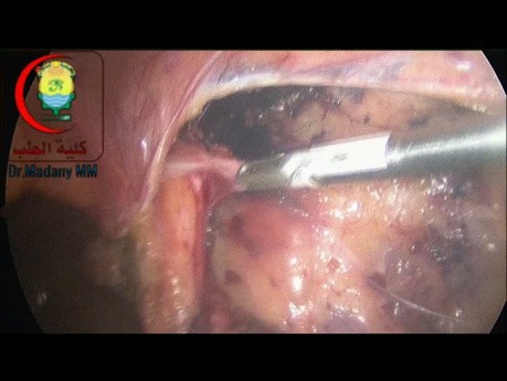 Chirurgie TAPP (Transabdominale Perpéritonéale) avec Présence de Lipome du cordon
