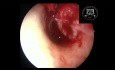 Myringoplastie endoscopique