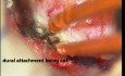 Tumeur de la Moelle Epinière - Méningiome Intra-Dural - Microchirurgie