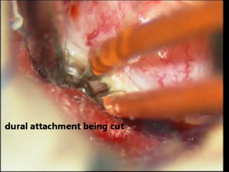 Tumeur de la Moelle Epinière - Méningiome Intra-Dural - Microchirurgie