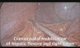 Proctocolectomie totale avec anastomose iléo‐anale par voie laparoscopique