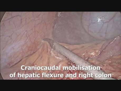 Proctocolectomie totale avec anastomose iléo‐anale par voie laparoscopique