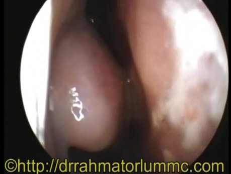 Rhinite Allergique 