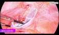 Prise en charge laparoscopique de la hernie incisionnelle suprapubienne