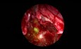 Fuite du LCR du Sinus Sphénoïde - Fluorescéine Intrathécale