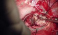 Chirurgie des Tumeurs Trigonales