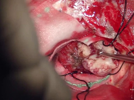 Chirurgie des Tumeurs Trigonales