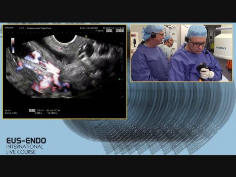 Échographie endoscopique (EUS) et cholangio-pancréatographie rétrograde endoscopique (CPRE)