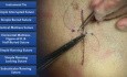 Point de Blair-Donati - les techniques de la suture