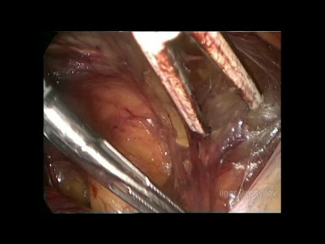 Prise en charge de la hernie inguinale contenant de la vessie par la voie coelioscopique totalement extrapéritonéale