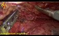 Œsophagectomie Thoraco-Laparoscopique - Partie Thoracique 4