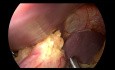Chirurgie Nissen - Focus sur la Dissection et la Mobilisation